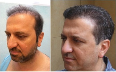 زراعة الشعر في تركيا بتقنية الاقتطاف FUE Hair Transplant Turkey